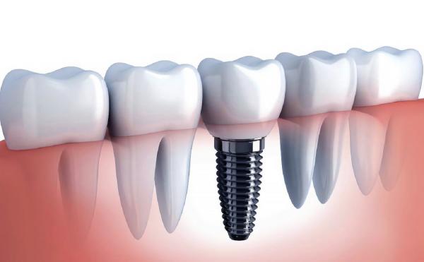 О перспективах развития зубной импланталогии в свете развития биотехнологий говорили в ИЦиГ