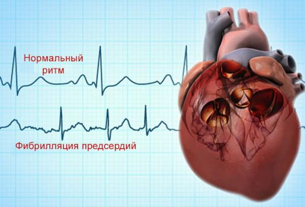 Сотрудники клиники Мешалкина на первом месте в мире по ведению пациентов с распространённым нарушением ритма сердца