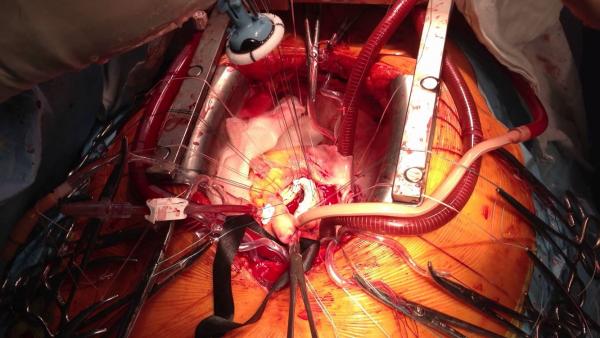 Ученые ННИИПК  им. Е.Н. Мешалкина разрабатывают бесшовный протез аортального клапана сердца
