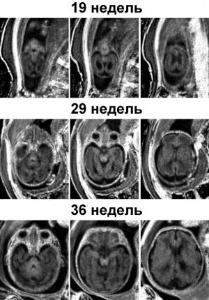 С использованием 1,5Т томографа Philips на базе МТЦ СО РАН проведено уникальное исследование, показывающее, в каких структурах мозга и в какие периоды его развития начинает формироваться миелин