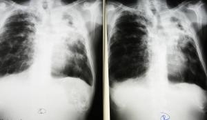 Рентгеновские снимки больного туберкулезом