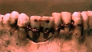 Фотографию черепа мумии с «зубным мостом» в свое время опубликовали во многих СМИ