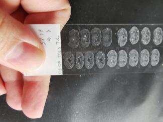 Ученые из России сделали шаг к созданию первого лекарства от аутизма