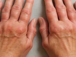 Как обеспечить россиян необходимым лечением ревматических заболеваний Как обеспечить россиян необходимым лечением ревматических заболеваний