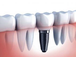 О перспективах развития зубной импланталогии в свете развития биотехнологий говорили в ИЦиГ
