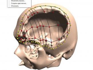 Студент Новосибирского государственного технического университета (НГТУ) Александр Гриф придумал первую в России технологию, создающую индивидуальные импланты для людей с черепно-мозговыми травмами. В будущем разработка позволит печатать индивидуальный имплант на 3D-принтере, что сократит издержки при операциях за счет экономии титана, используемого при операциях, сообщила в четверг сообщила пресс-служба вуза. "Компьютерная программа позволяет отказаться от стандартных пластин, с ее помощью можно создавать 