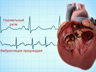 Сотрудники клиники Мешалкина на первом месте в мире по ведению пациентов с распространённым нарушением ритма сердца